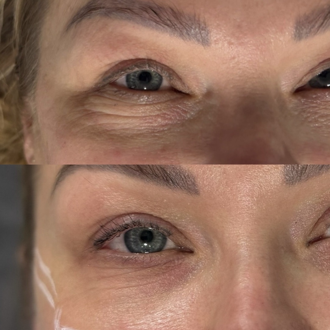 Vitaran polynukleoitidihoito silmien alle tehtynä (ennen/jälkeen) C Blume Clinic